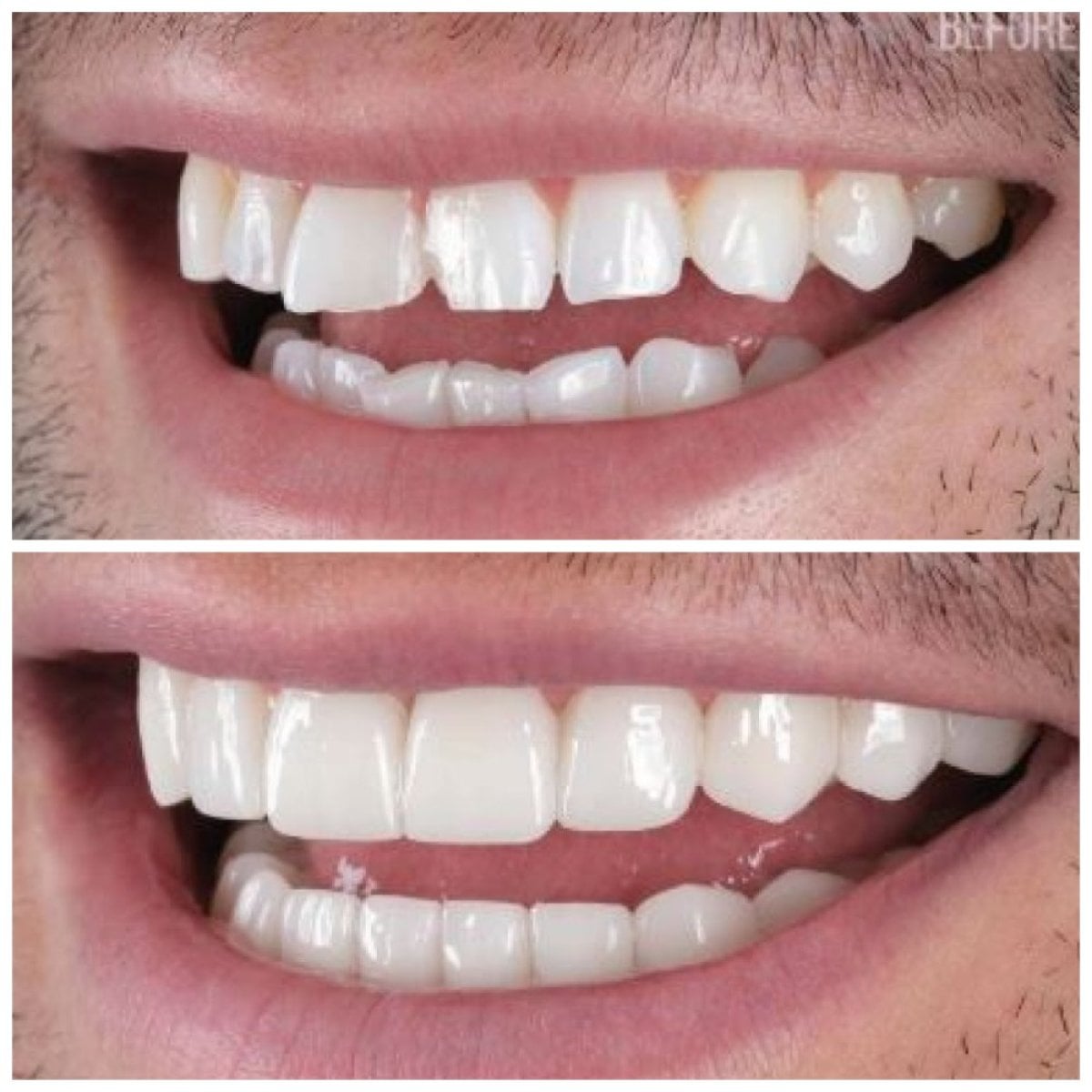 نتائج قبل وبعد ترابط الأسنان في Santa Caterina Clinic Dental & Aesthetic Medicine