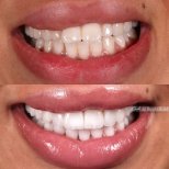 قبل وبعد الفينير في عيادة Dental Ezel، تحول الابتسامة بنتائج طبيعية المظهر