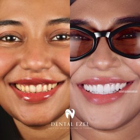 نتائج قبل وبعد الفينير في عيادة Dental Ezel، ابتسامة أكثر بياضًا وتناسقًا