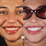 نتائج قبل وبعد الفينير في عيادة Dental Ezel، ابتسامة أكثر بياضًا وتناسقًا