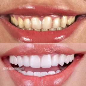 قبل وبعد الفينير في عيادة Dental Ezel – تحول الابتسامة بنتائج طبيعية
