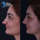 نتائج تجميل الأنف قبل وبعد في عيادة د. حسن دويغولو، تحسين شكل الأنف الجانبي