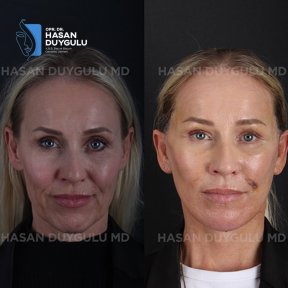Результати до і після реконструкції обличчя в клініці Dr. Hasan Duygulu Private Practice
