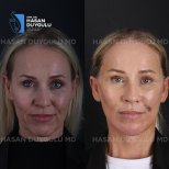 Результати до і після реконструкції обличчя в клініці Dr. Hasan Duygulu Private Practice