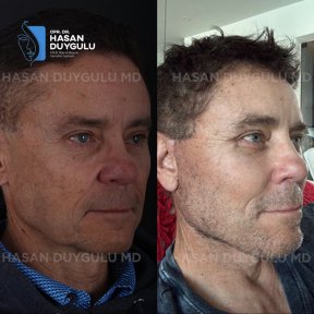 Результати ринопластики до і після в клініці Dr. Hasan Duygulu, покращена форма носа