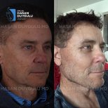 Результати ринопластики до і після в клініці Dr. Hasan Duygulu, покращена форма носа