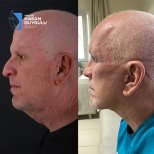 Результати підтяжки обличчя до і після в Dr. Hasan Duygulu, помітне підтягнення шиї
