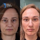 Результати ринопластики до і після у клініці Dr. Hasan Duygulu, корекція носа