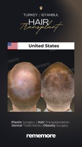 before-after photo eyebrow-transplantation