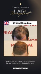 before-after photo eyebrow-transplantation