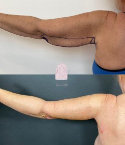 before-after photo breast-reduction
