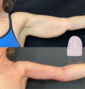 before-after photo breast-reduction
