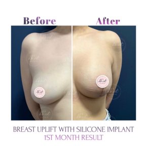 before-after photo breast-augmentation