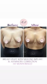 before-after photo breast-augmentation