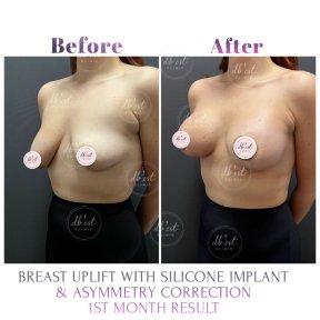 before-after photo breast-augmentation
