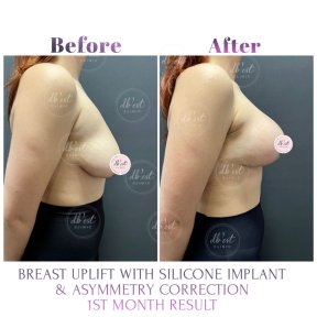 before-after photo breast-augmentation