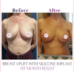 before-after photo breast-augmentation