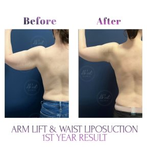 before-after photo breast-augmentation