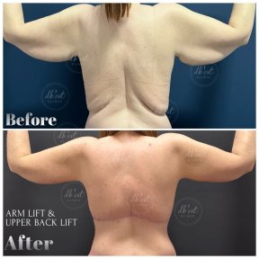 before-after photo breast-augmentation