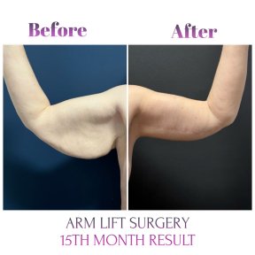 before-after photo breast-augmentation