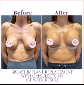 before-after photo breast-augmentation