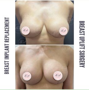 before-after photo breast-augmentation