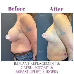 before-after photo breast-augmentation