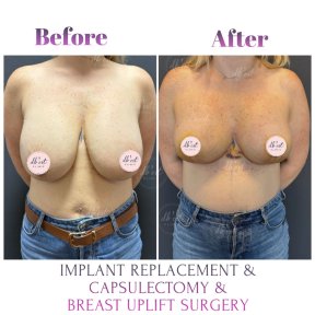 before-after photo breast-augmentation