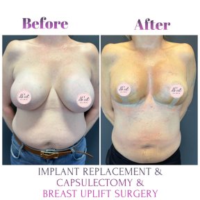 before-after photo breast-augmentation