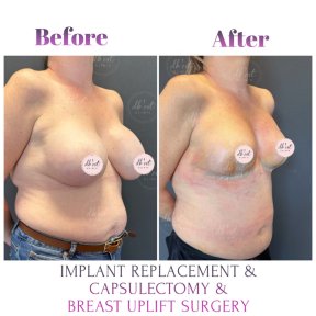 before-after photo breast-augmentation