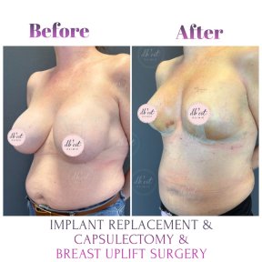 before-after photo breast-augmentation