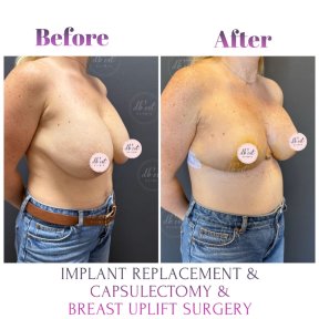 before-after photo breast-augmentation