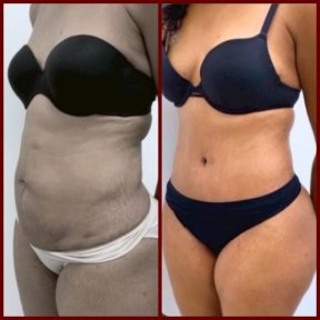 before-after photo vaser-liposuction