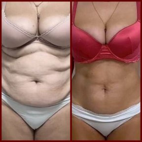 before-after photo vaser-liposuction