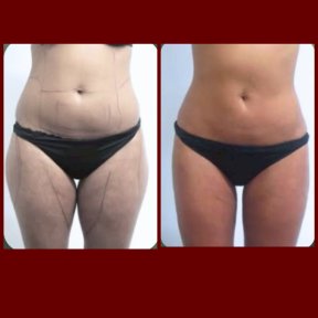 before-after photo vaser-liposuction