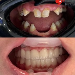 before-after photo dental-implant