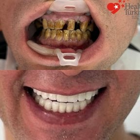 before-after photo dental-implant