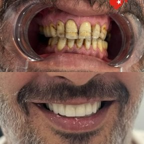 before-after photo dental-implant