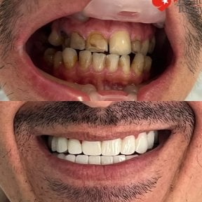 before-after photo dental-implant