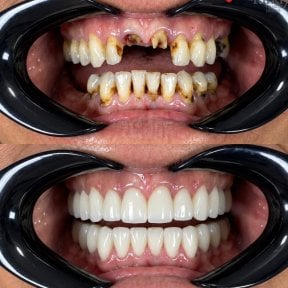 before-after photo dental-implant