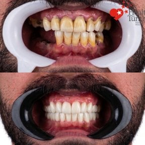 before-after photo dental-implant
