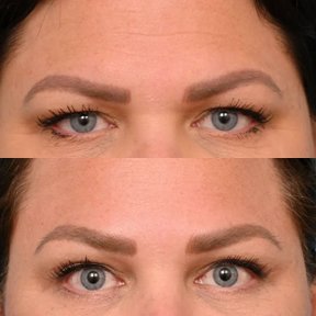 before-after photo brow-lift