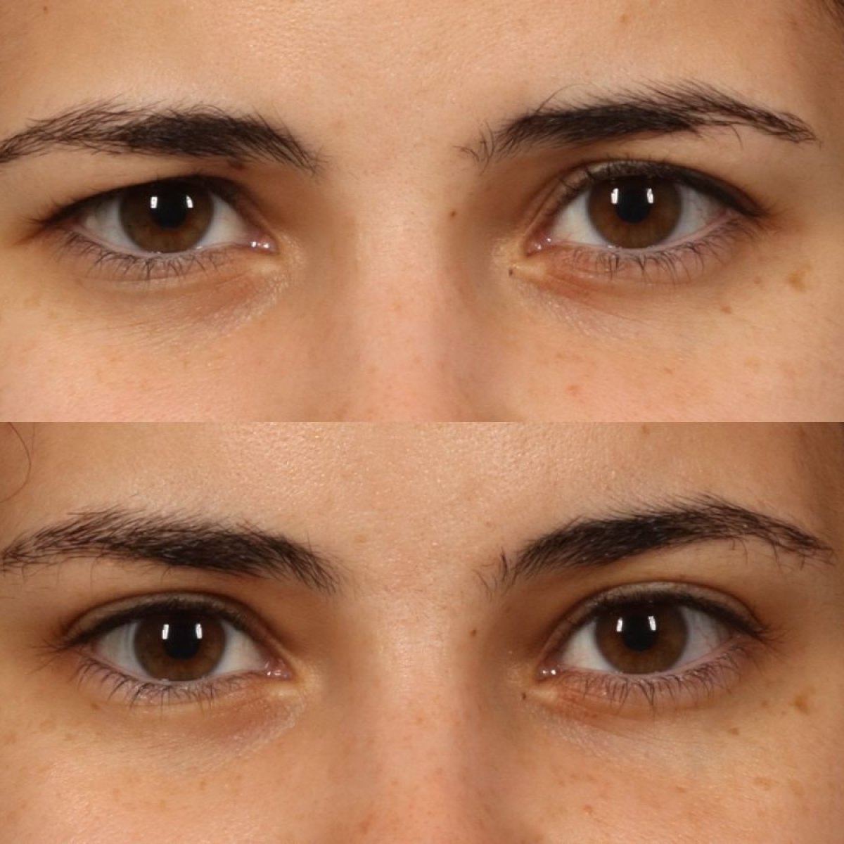 Resultados antes y después de lifting de cejas en Dr. Alexandro Aguilera - Plastic Surgery, rejuvenecimiento ocular