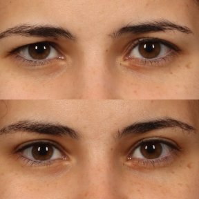 before-after photo brow-lift