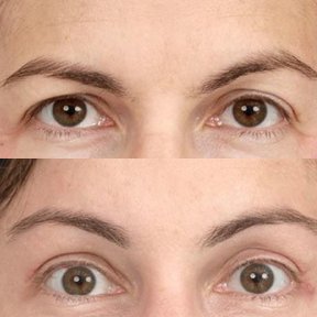 before-after photo brow-lift