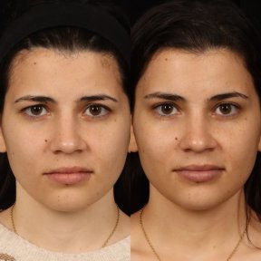 before-after photo brow-lift