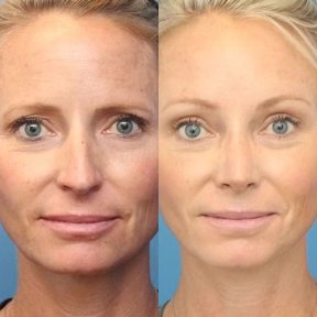 before-after photo brow-lift