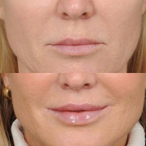 before-after photo lip-lift