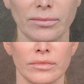 before-after photo lip-lift