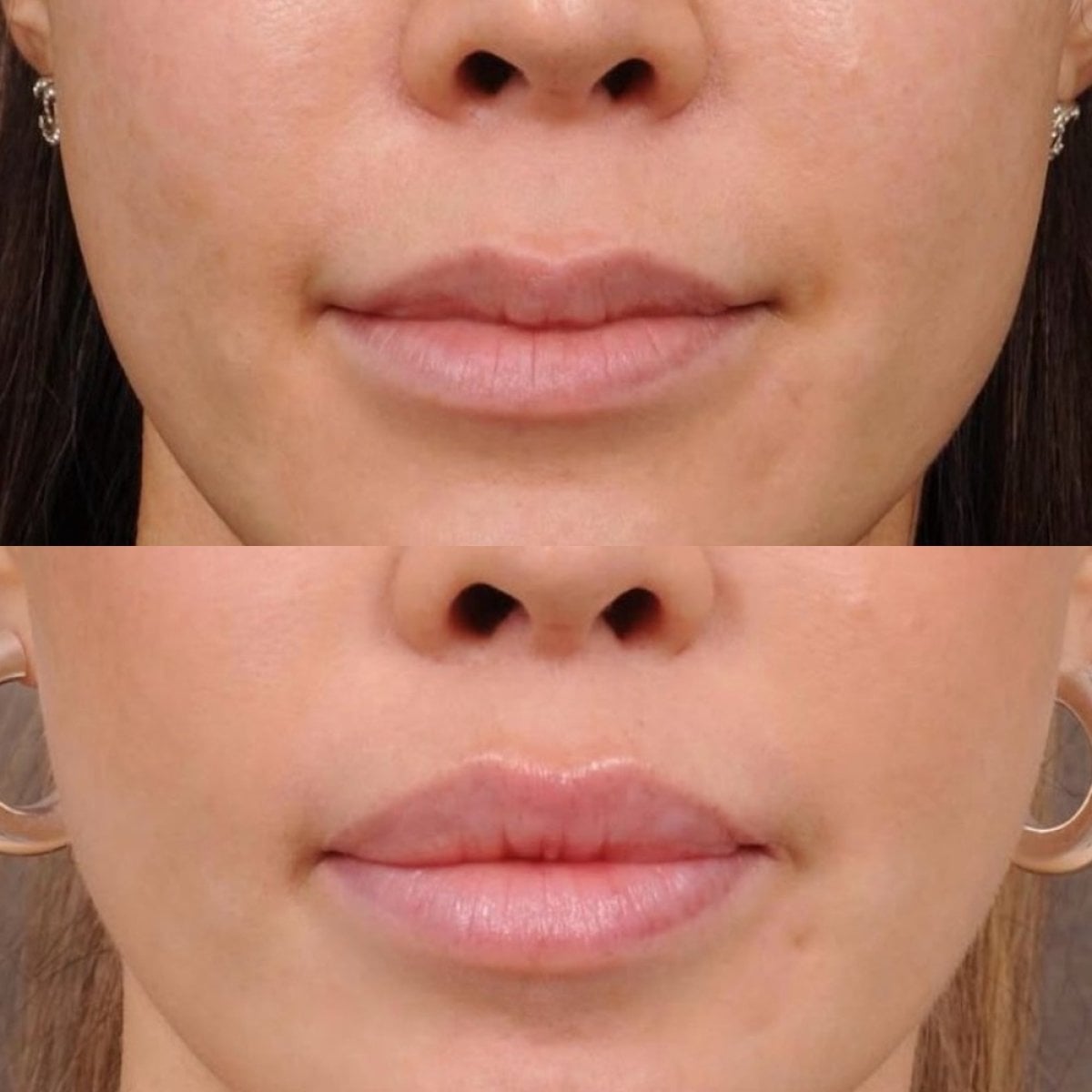 نتائج قبل وبعد رفع الشفاه في Dr. Alexandro Aguilera - Plastic Surgery، تحديد الشفاه المحسن